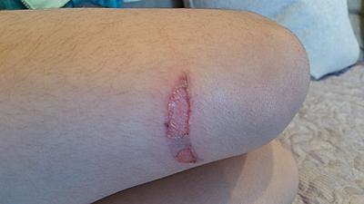 Warning: Q5 3rd degree burn on my 4 year old's leg-20170512_182211.jpg